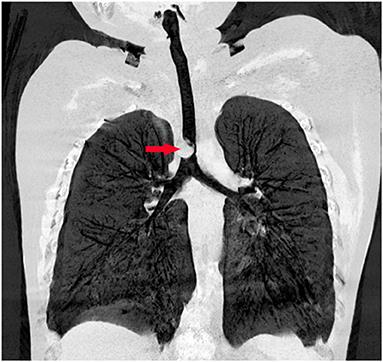 Case Report: Resection of Giant Endotracheal Hamartoma by Electrosurgical Snaring via Fiberoptic Bronchoscopy in a 9-Year-Old Boy